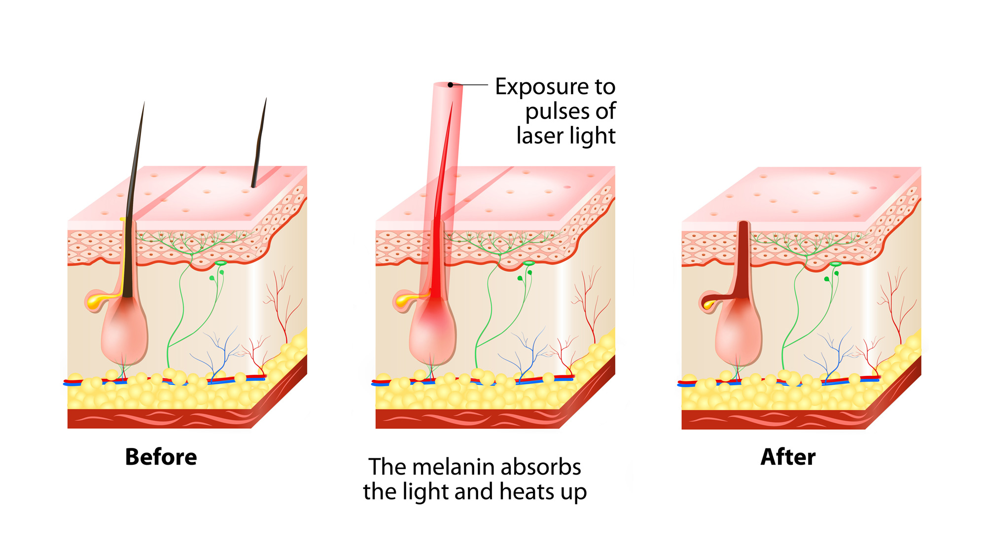 IPL or Diode Laser? Advantages of diode over IPL